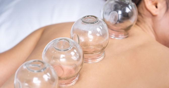 Cupping Therapy